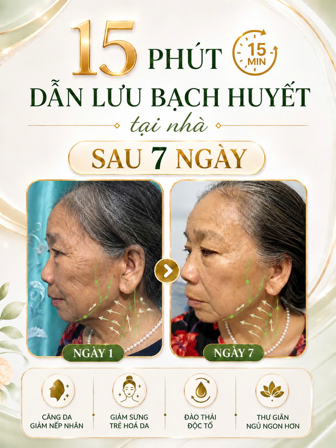 Kết quả dẫn lưu bạch huyết vùng cổ - căng da, giảm nếp nhăn sau 7 ngày