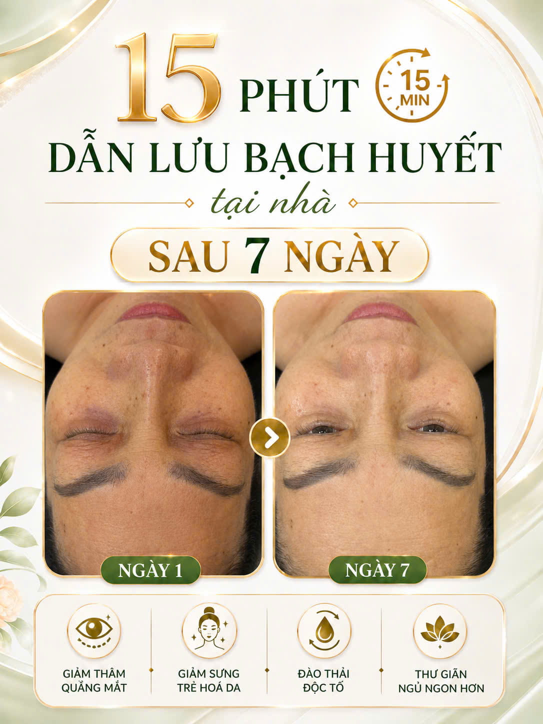 Kết quả dẫn lưu bạch huyết vùng mắt - giảm thâm quầng mắt sau 7 ngày
